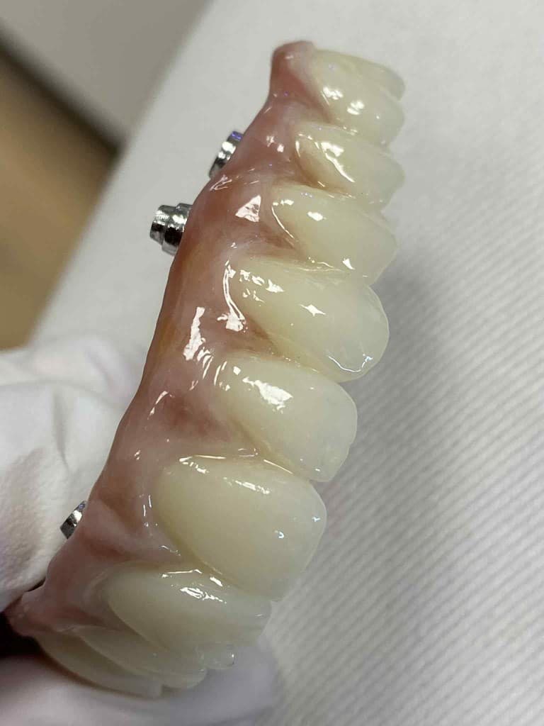 Implantat-Suprakonstruktionen